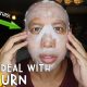 How I Deal With Sunburn | Vlog #168